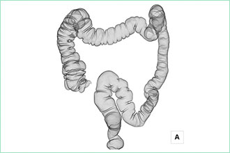 大腸CT画像