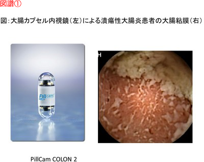 大腸カプセル内視鏡（左）による潰瘍性大腸炎患者の大腸粘膜（右）