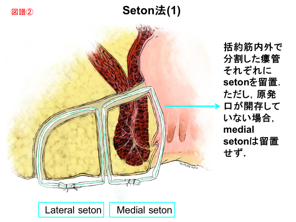 Seton法（1）
