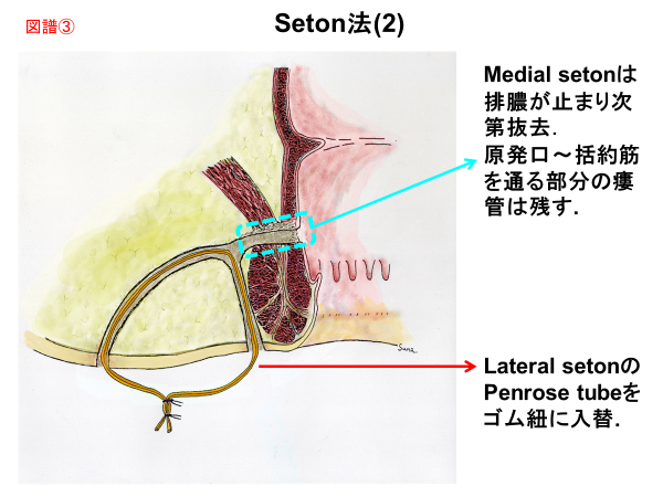 Seton法（2）