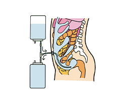 腹膜透析について